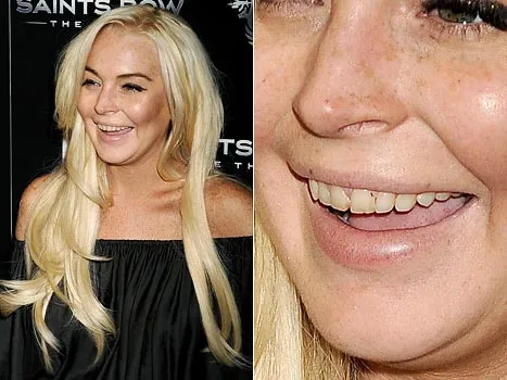 1318524824_lindsay lohan teeth article