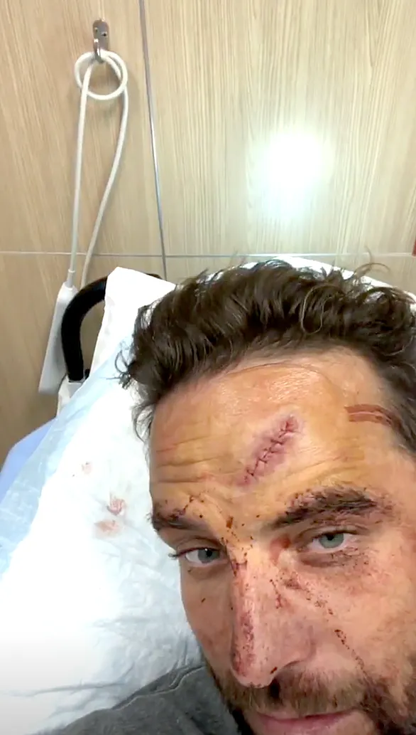 TJ-Lavin-Injured-in-BMX-Jump-stitches