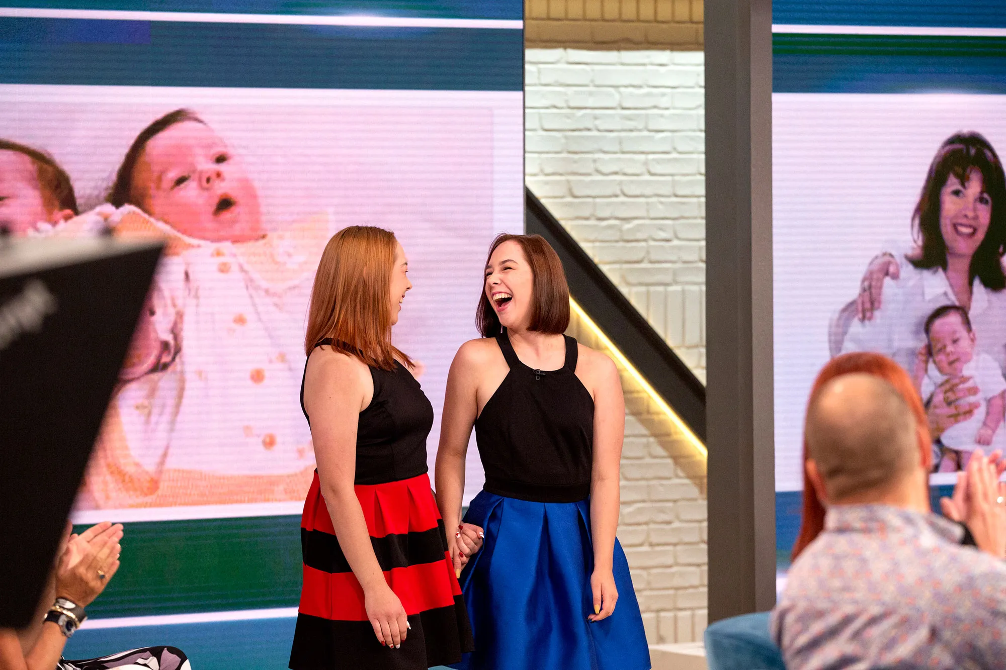 conjoined twins separted 17 years