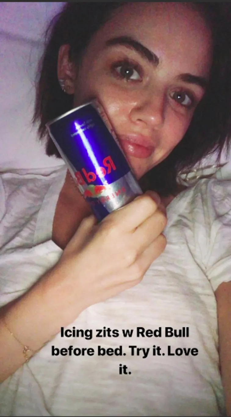 Lucy Hale&rsquo;s Zit-Zapping Trick Involves a Trip to the Refrigerator: &rsquo;Try It&rsquo;