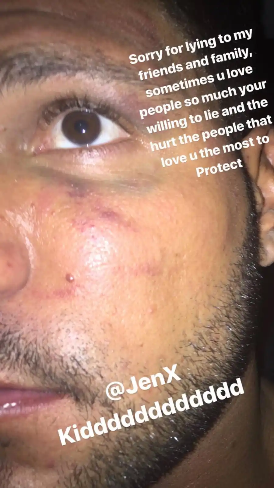 Ronnie-Magro-bruises-instagram