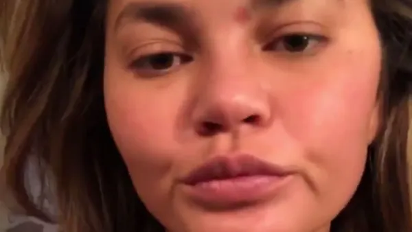 Chrissy Teigen Is Just Like Us, Has #SkinProbems