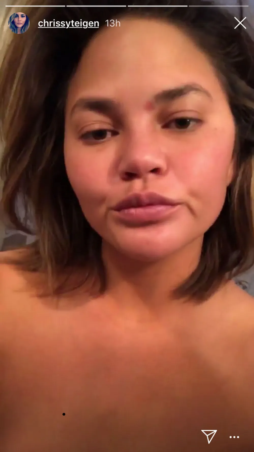 Chrissy Teigen Is Just Like Us, Has #SkinProbems