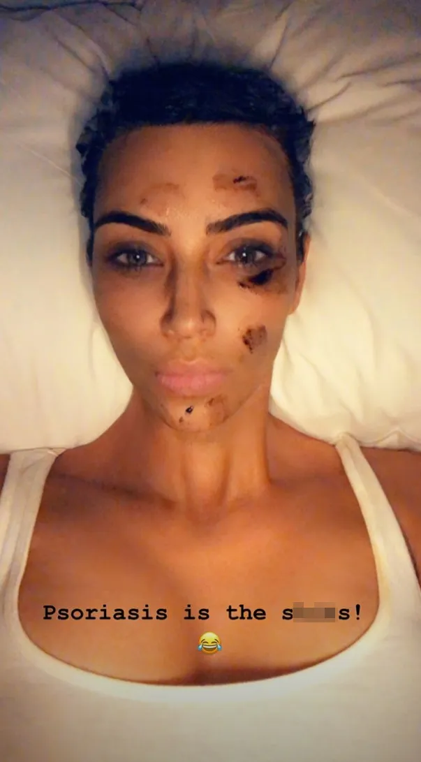Kim-Kardashian-Psoriasis