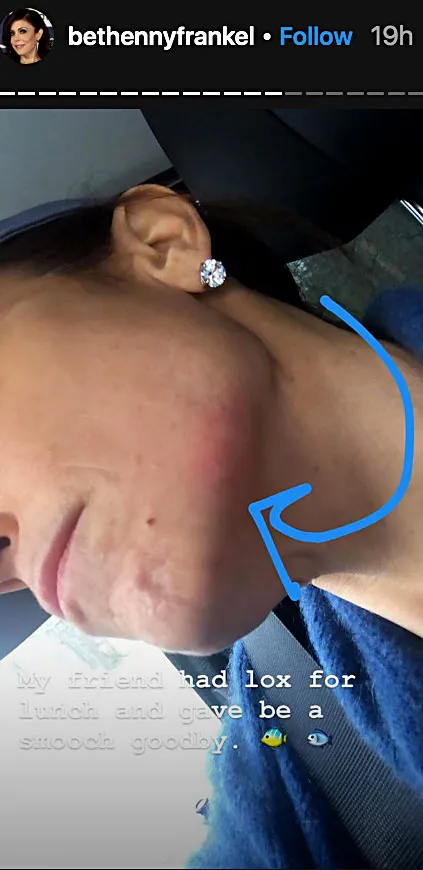 Bethenny Frankel Allergic Reaction