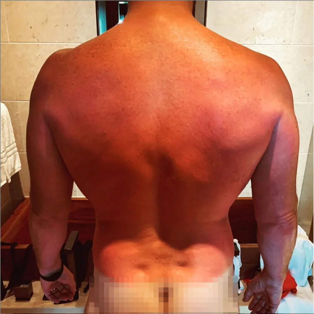 Chris Pratt Instagram Sun Burn