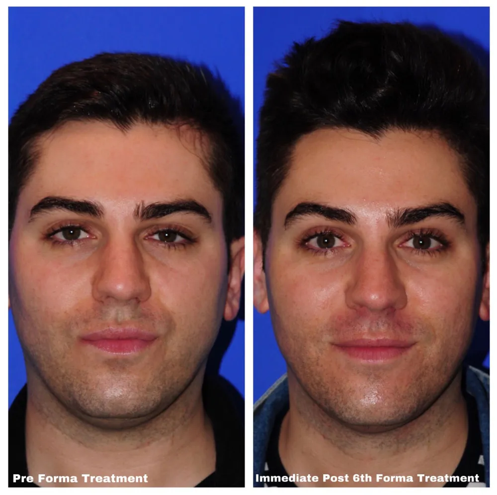 Marc Before & After Facial