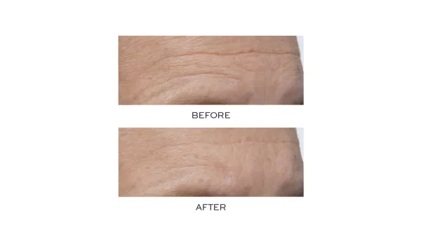 Before-and-After-Serum-Nordstrom