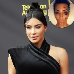 Kim Kardashian Gets Candid About Psoriasis, Diet Changes