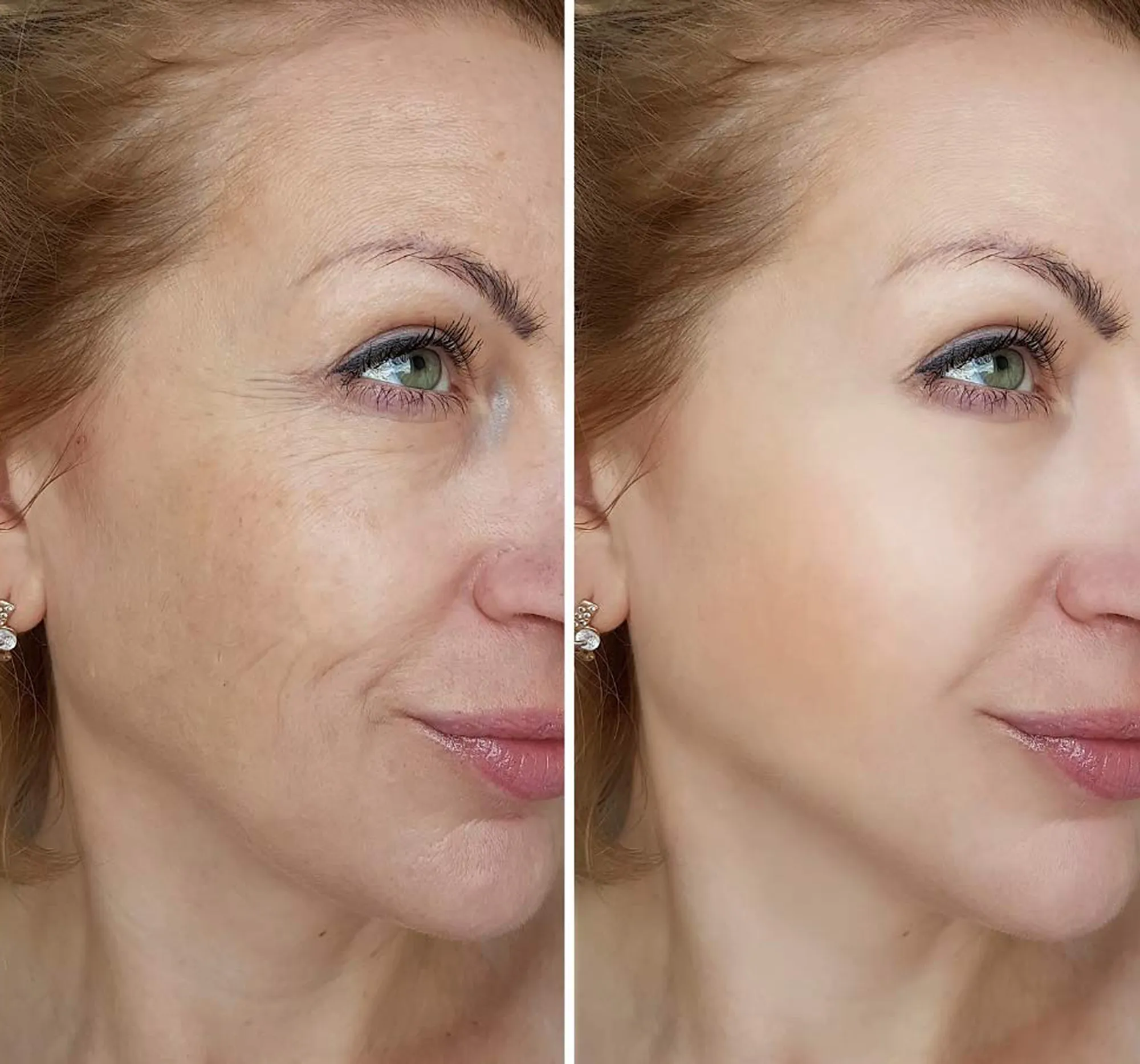 rosehip oil before and after