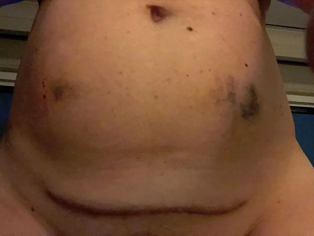 Amy Schumer Run Down After IVF