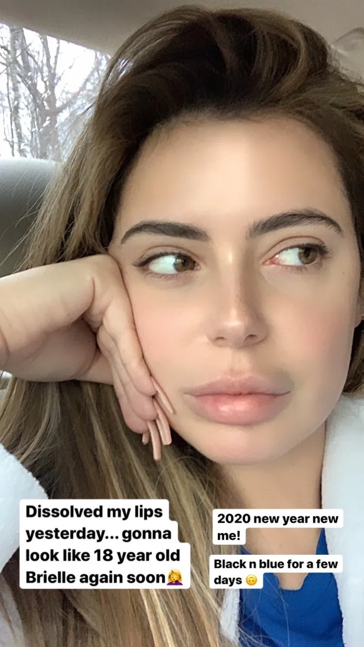 Brielle Biermann Says She Is Getting Her Lip Fillers Dissolved: Photo