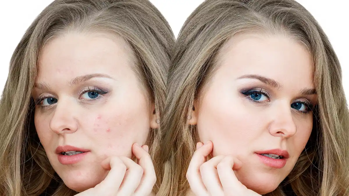 before-after-skin
