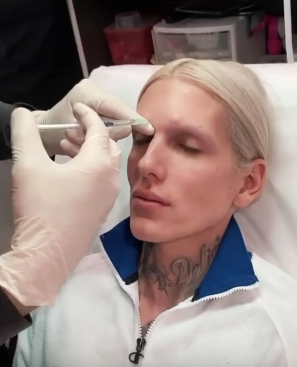 Jeffree Star Botox YouTube Video