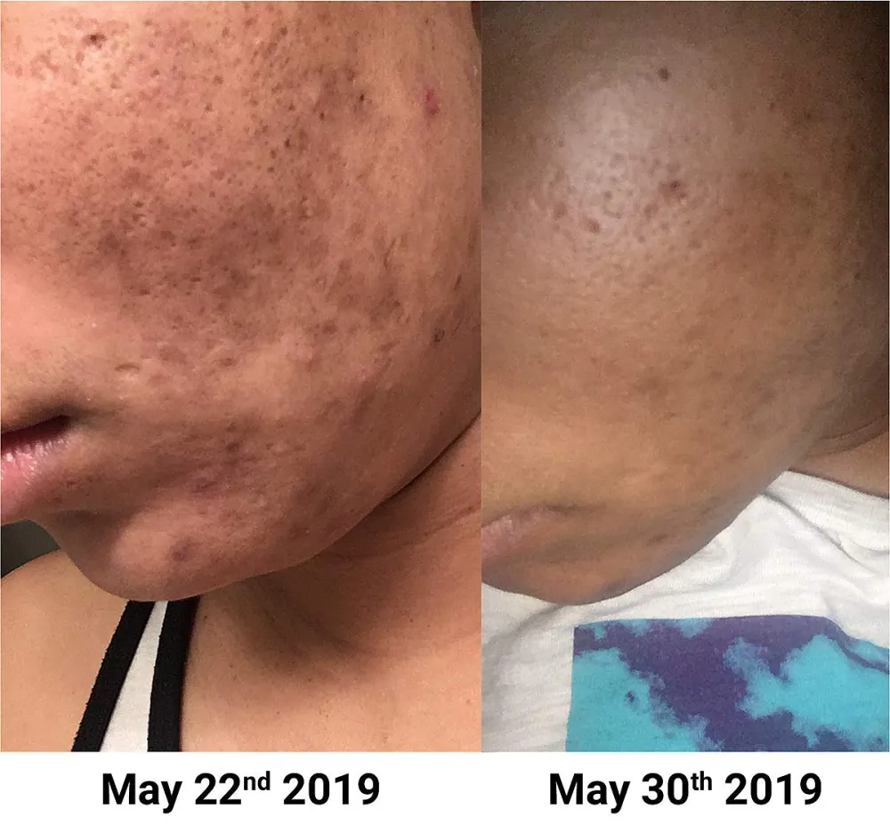 NxN Vitamin C & Hyaluronic Acid Anti Aging Serum Set