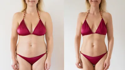 Before and After Weight Loss