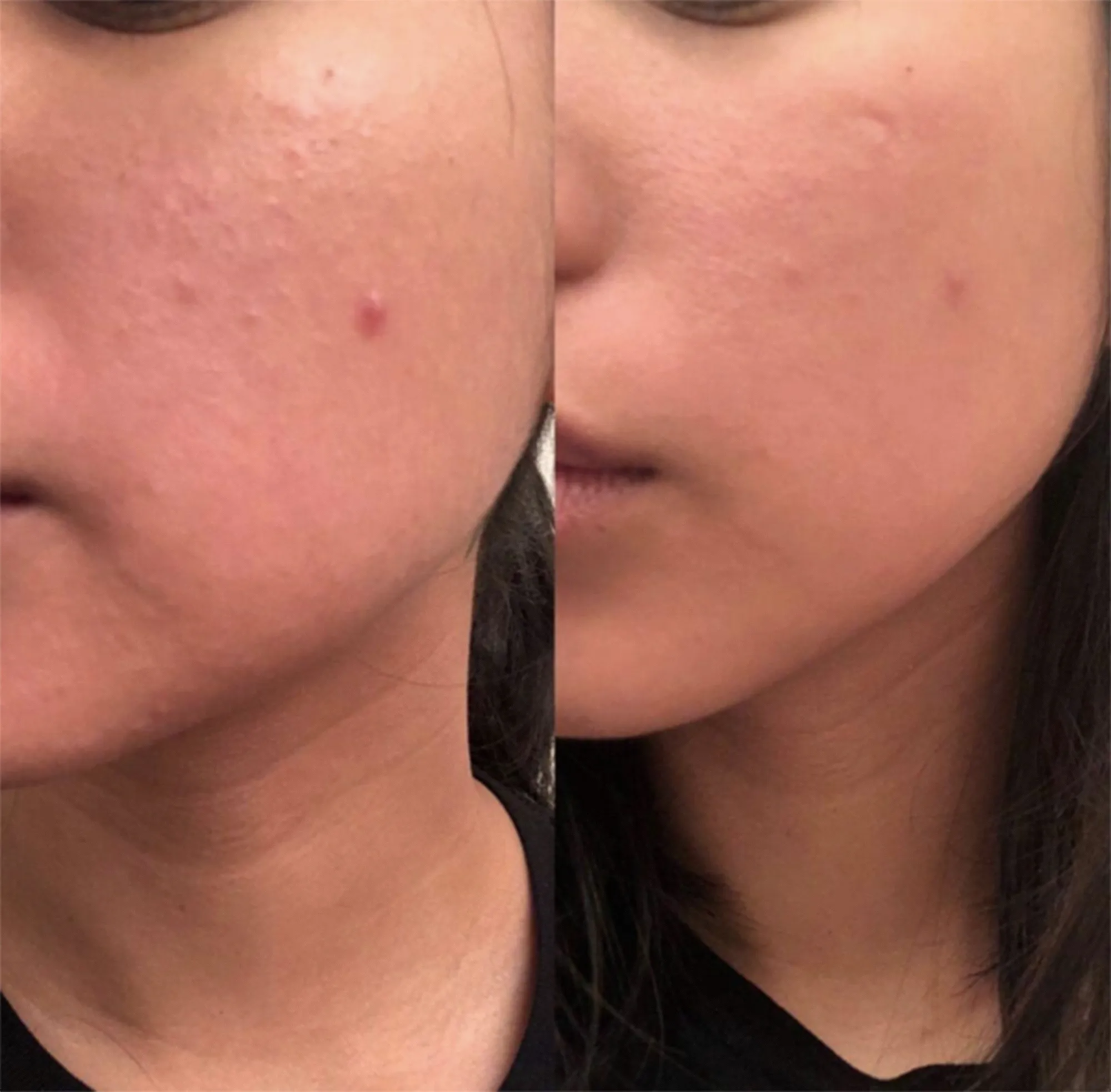 Sdara Skincare Derma Roller