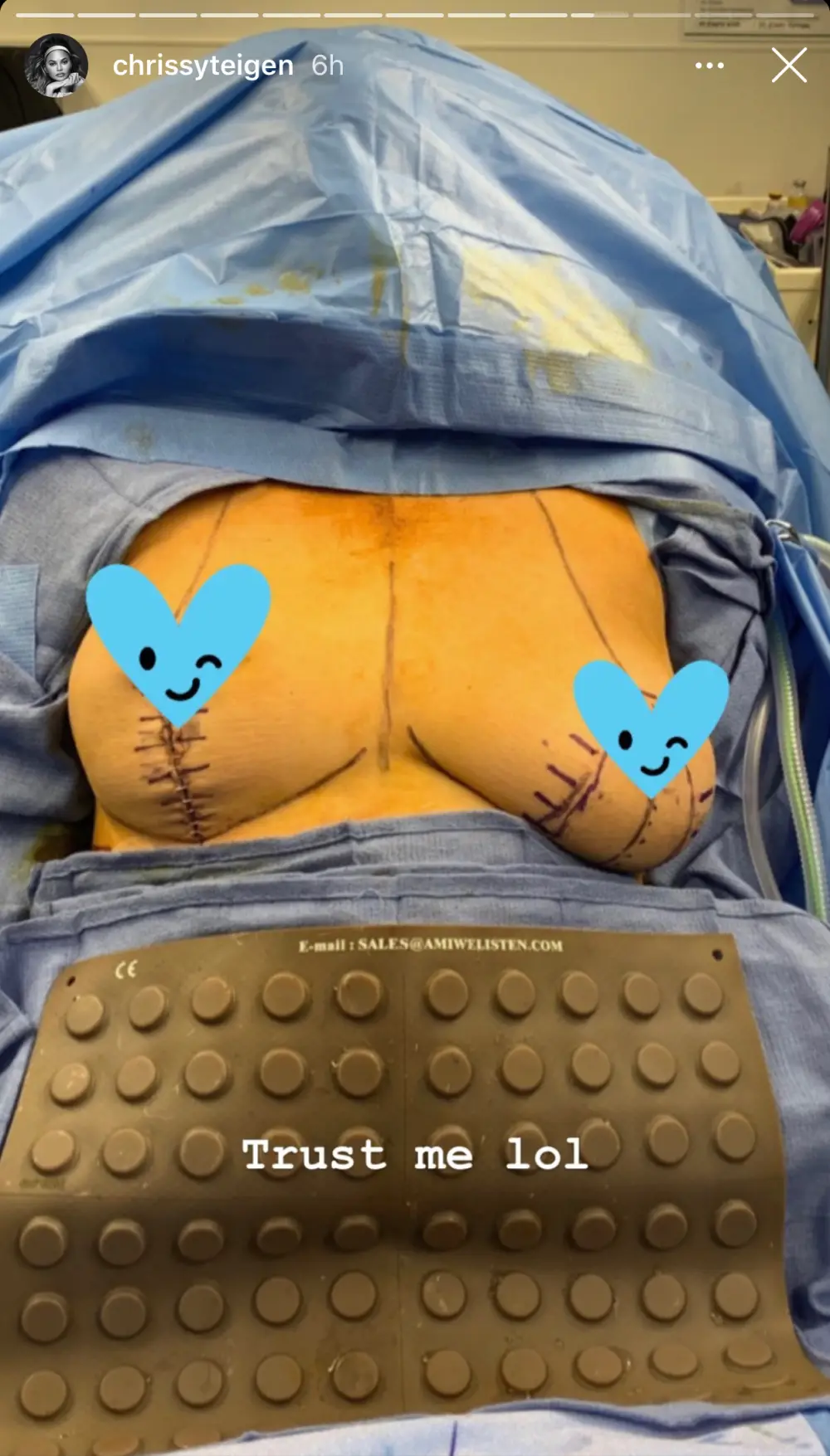 Chrissy Teigen Shares Pic of Breast Implant Removal Surgery and Scars