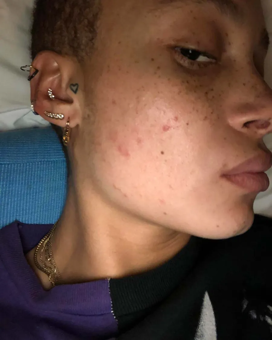 Stars Who’ve Normalized Adult Acne Through the Years: Pics