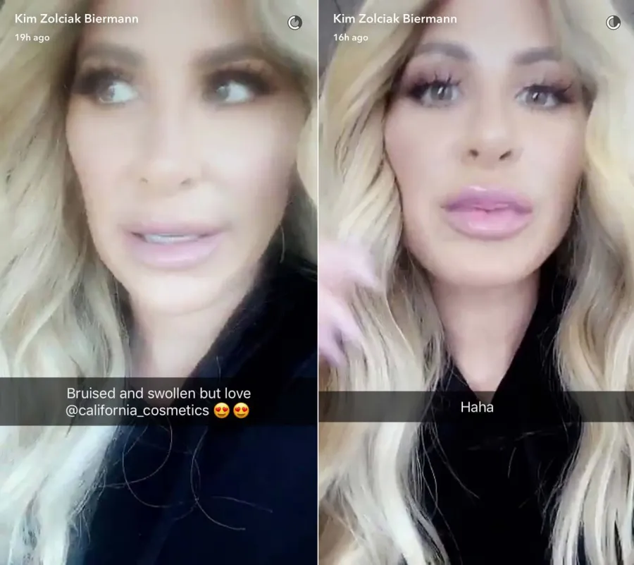 The Evolution of Kim Zolciak’s Beloved Lip Fillers: Pics