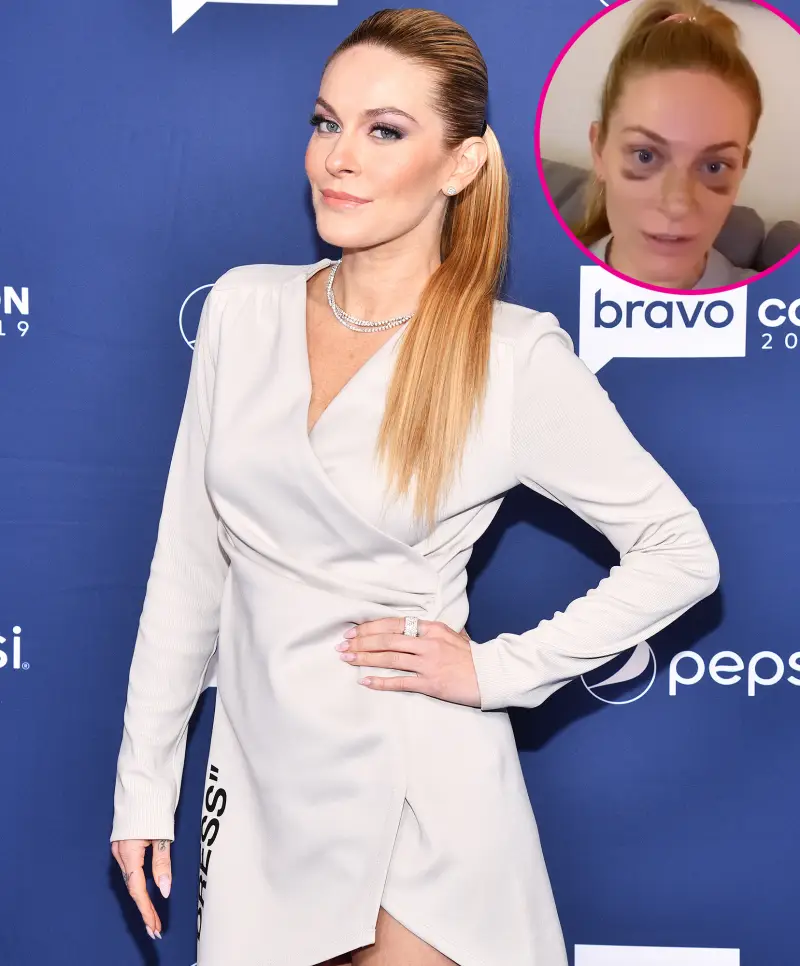 RHONY Leah McSweeney Reveals She Got a Nose Job p