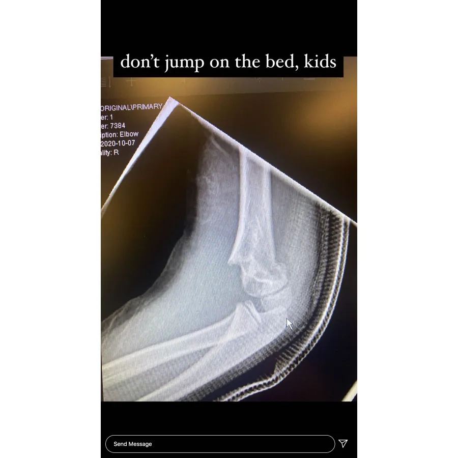 Amanda Stanton Daughter Charlie Has Surgery After Fracturing Arm