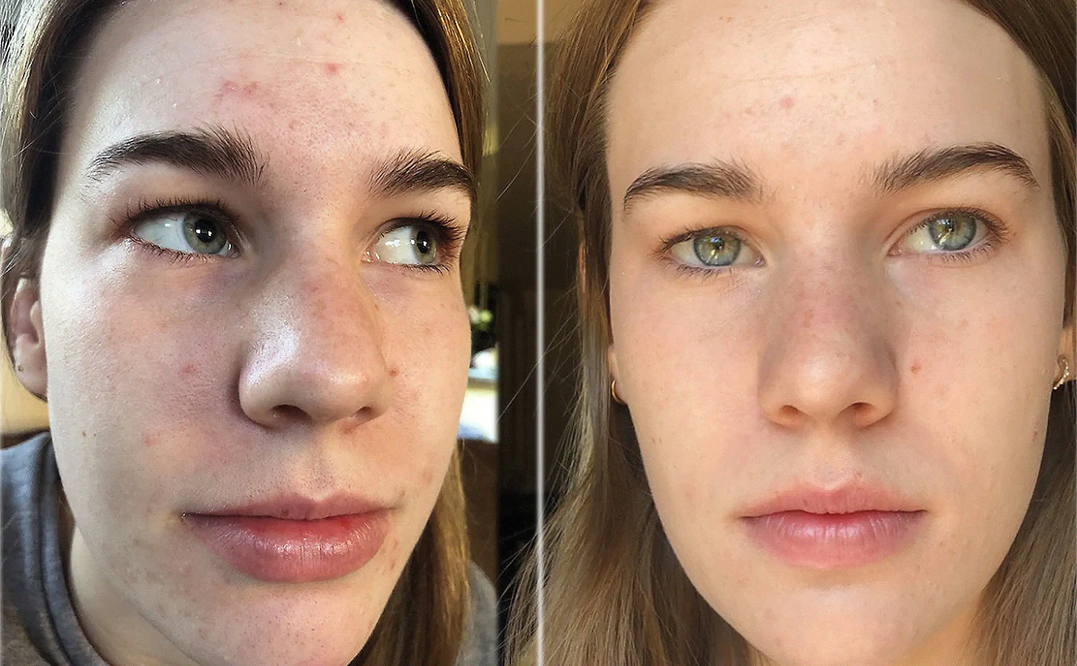 Dr. Zenovia Skincare 10% Benzoyl Peroxide Acne Cleanser