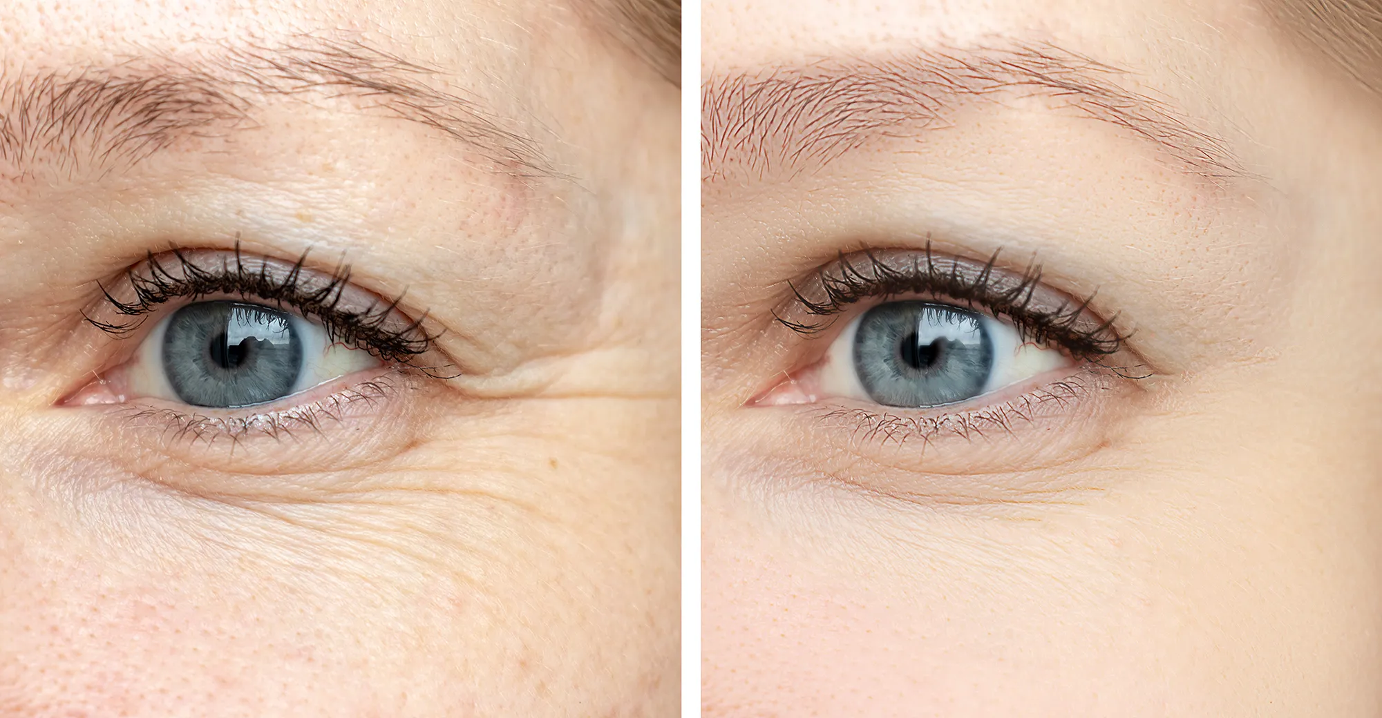 before-after-eye-wrinkles-serum-cream