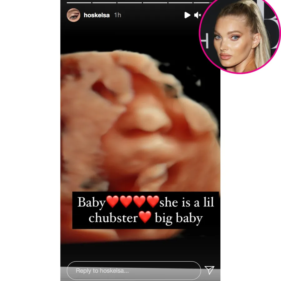 Elsa Hosk ultrasound