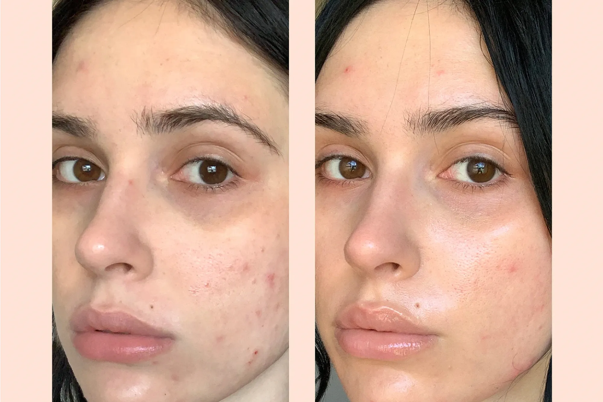 Acne Treatment Serum