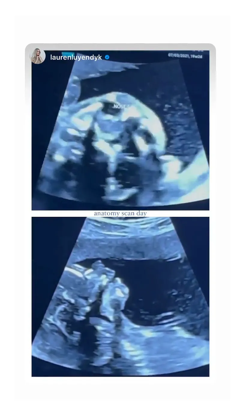 Arie Luyendyk Jr Isn't Allowed in Pregnant Lauren Burnham Ultrasound Appointment Amid Pandemic