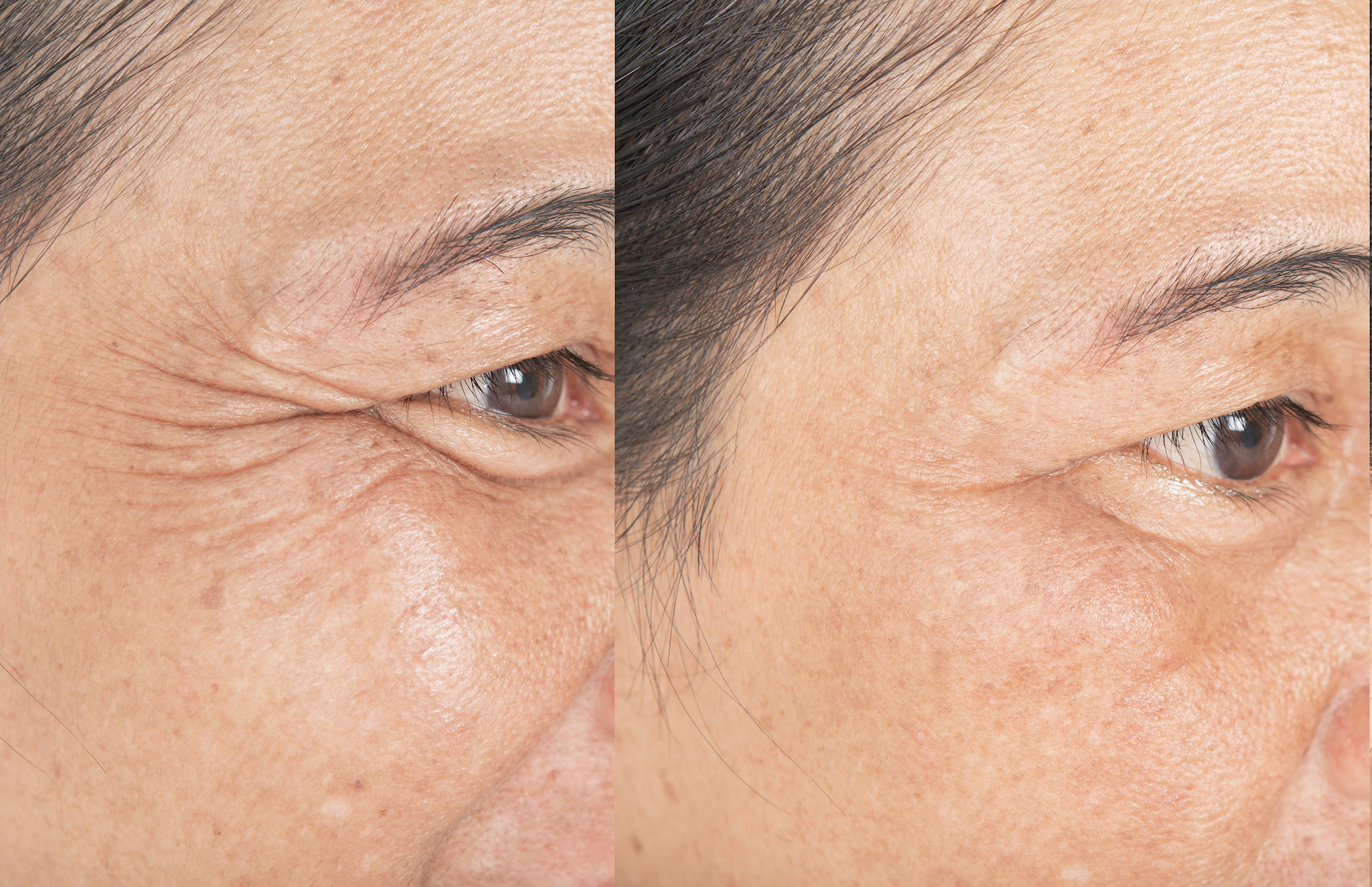 Before-After-Crows-Feet