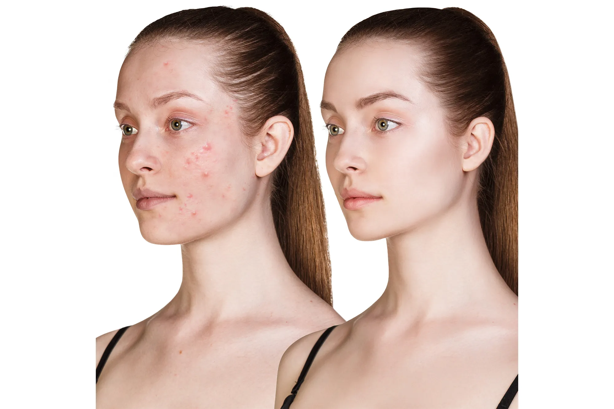 Before-After-Skincare-Stock-Photo