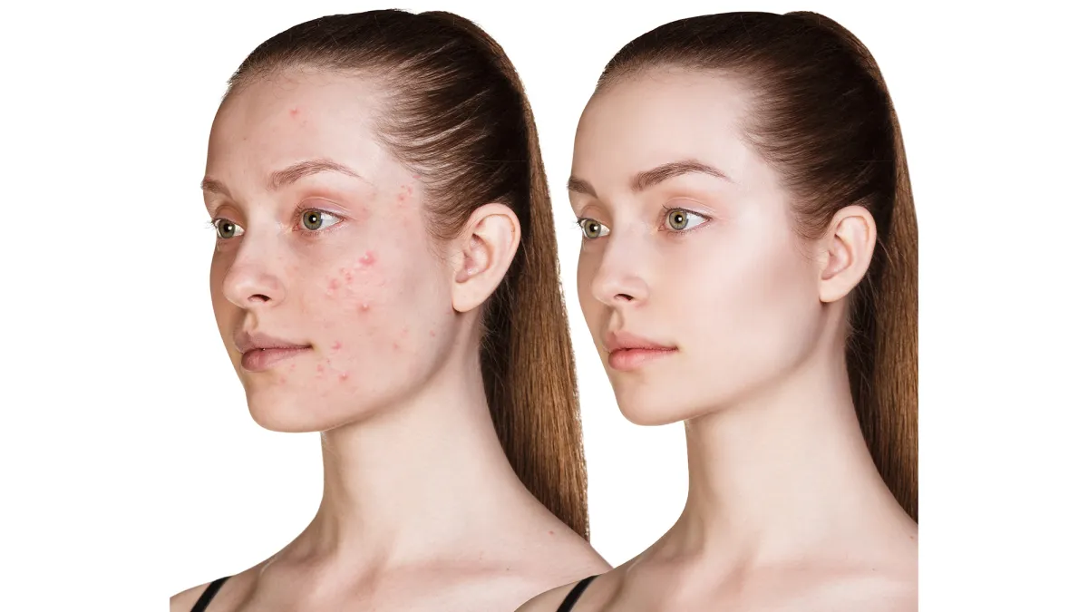 Before-After-Skincare-Stock-Photo