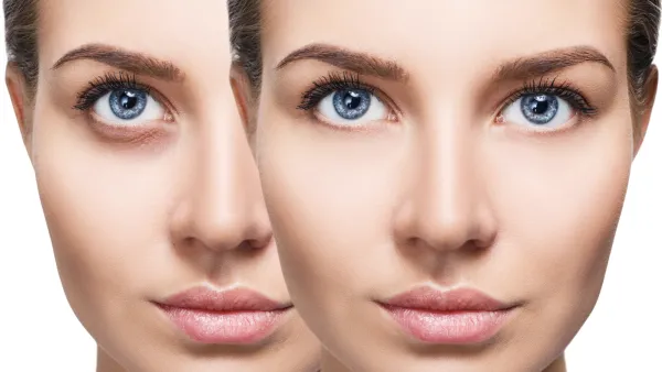 Dark-Circles-Before-After-Stock-Photo