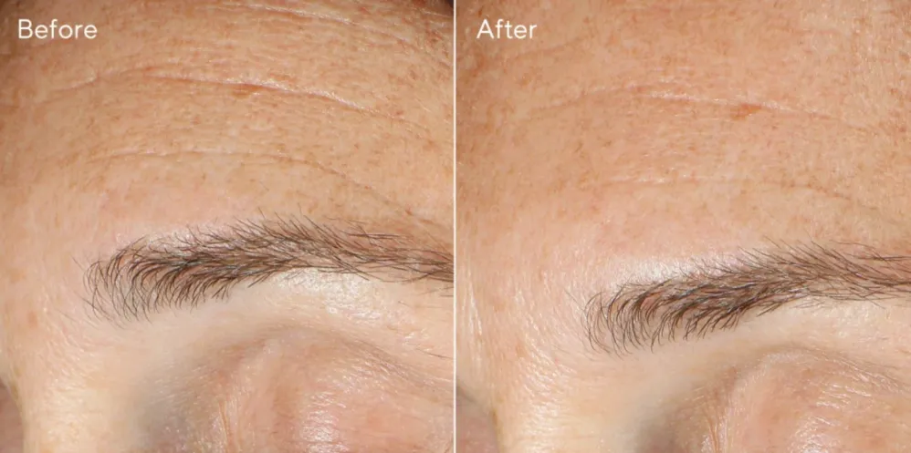 Replenishing Multi-Acid Peel