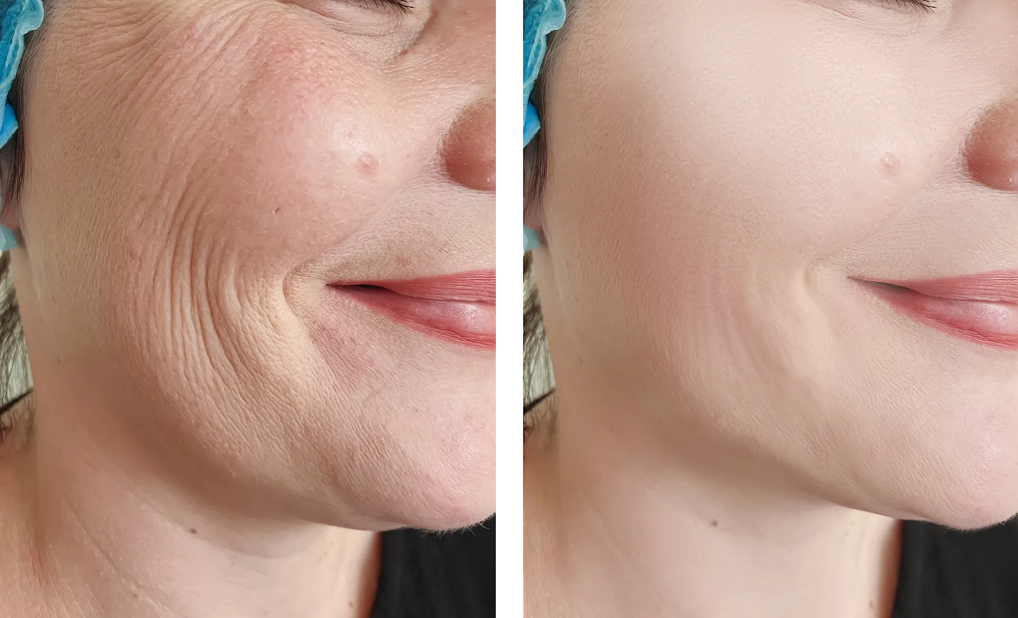 before-after-wrinkles