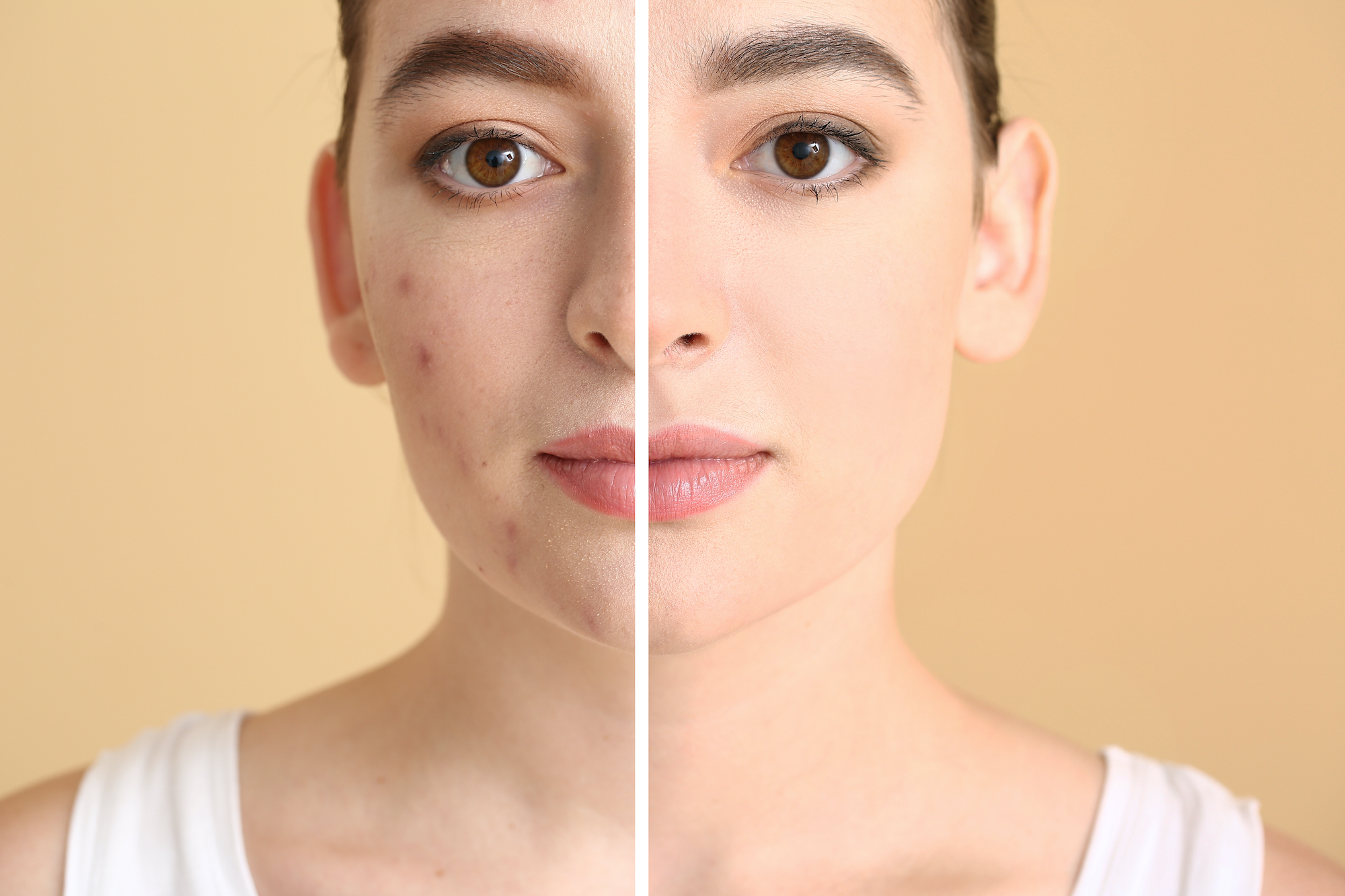 Acne-Treatment-Before-After-Stock-Photo