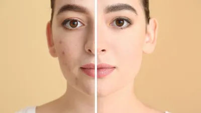 Acne-Treatment-Before-After-Stock-Photo