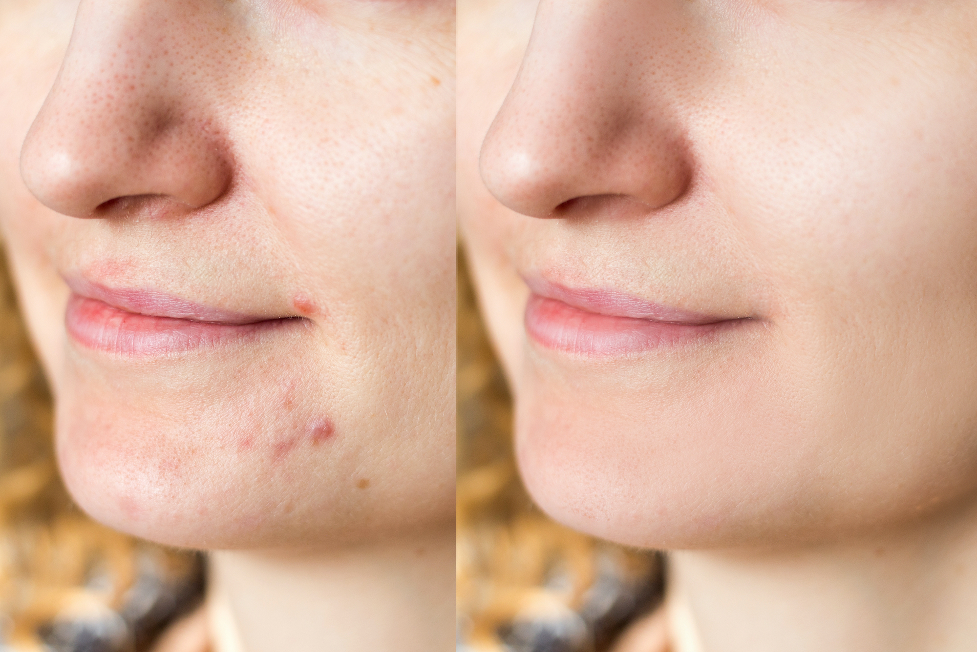 Before-After-Acne-Skincare-Stock-Photo