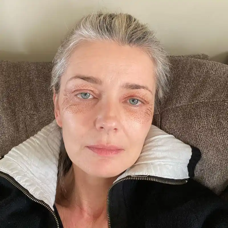 Paulina Porizkova, 55, Shows Off Puncture Marks from Anti-Aging Treatment: “I’m Vain and Want to Be Pretty’