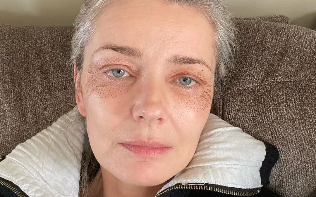 Paulina Porizkova, 55, Shows Off Puncture Marks from Anti-Aging Treatment: “I’m Vain and Want to Be Pretty’