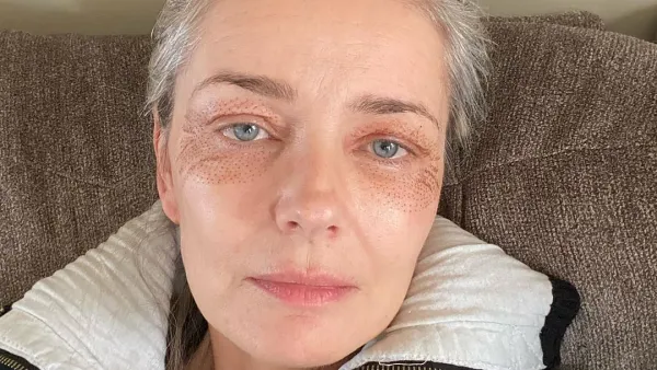 Paulina Porizkova, 55, Shows Off Puncture Marks from Anti-Aging Treatment: “I’m Vain and Want to Be Pretty’