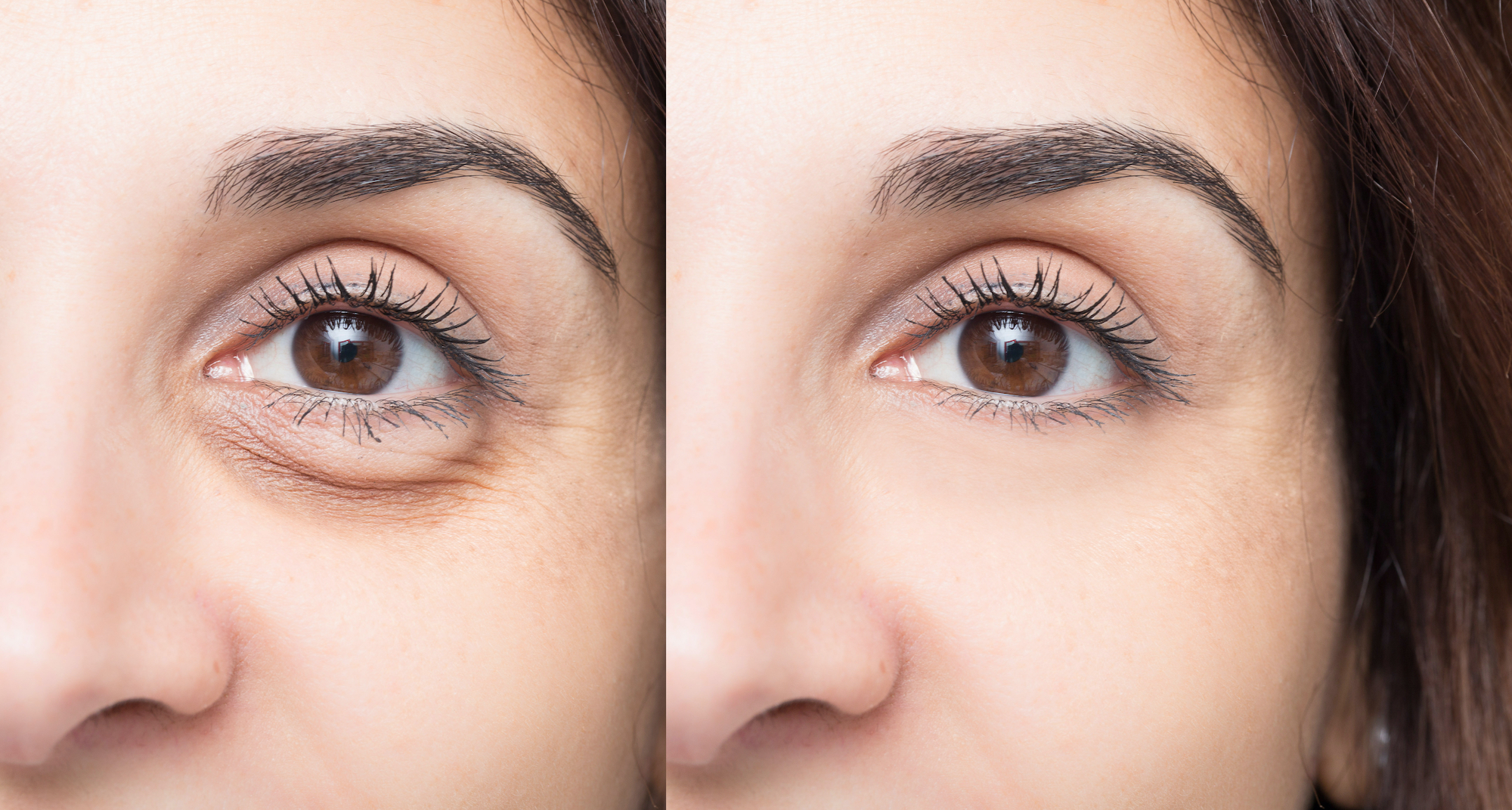 Puffy-Eyes-Before-After-Stock-Photo