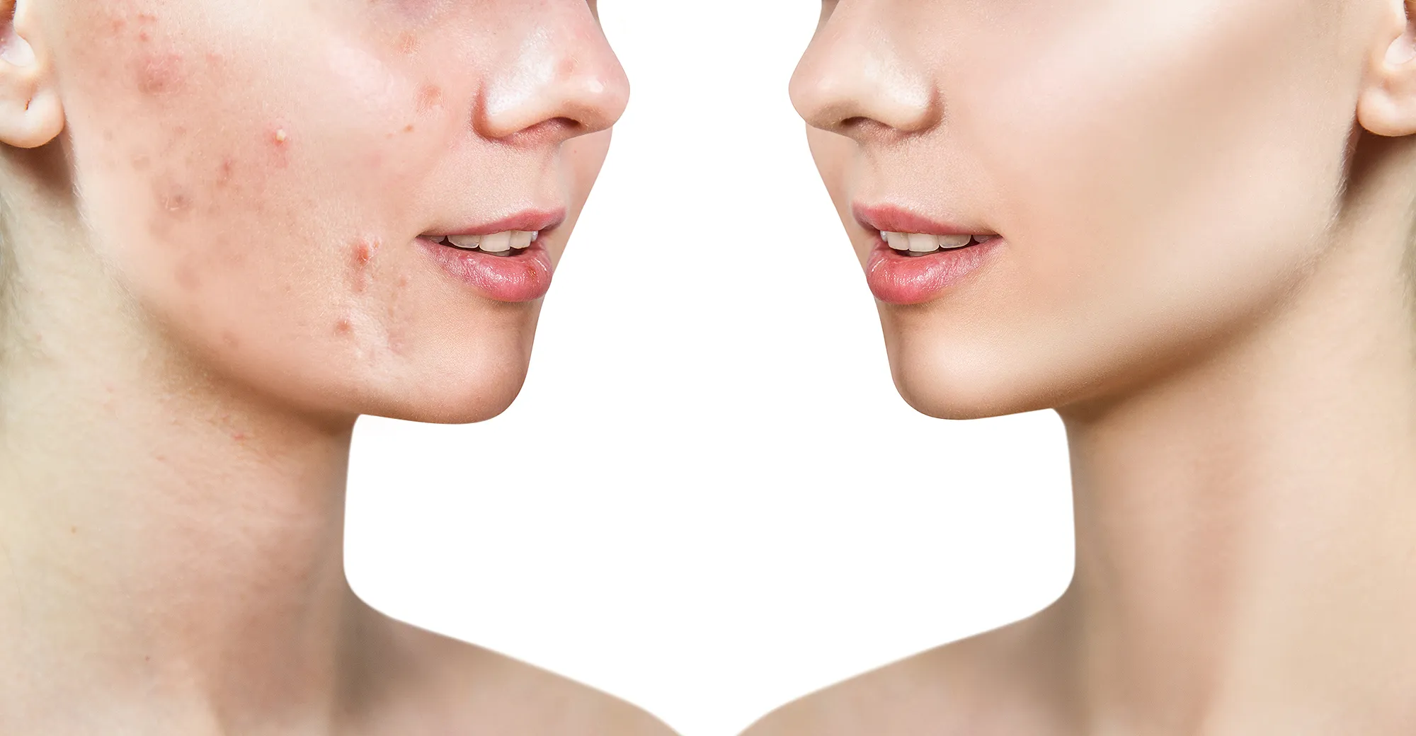 before-after-acne