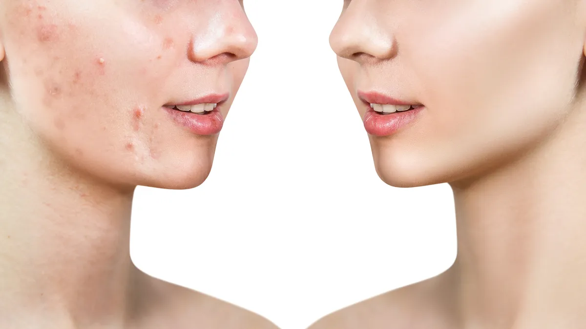 before-after-acne