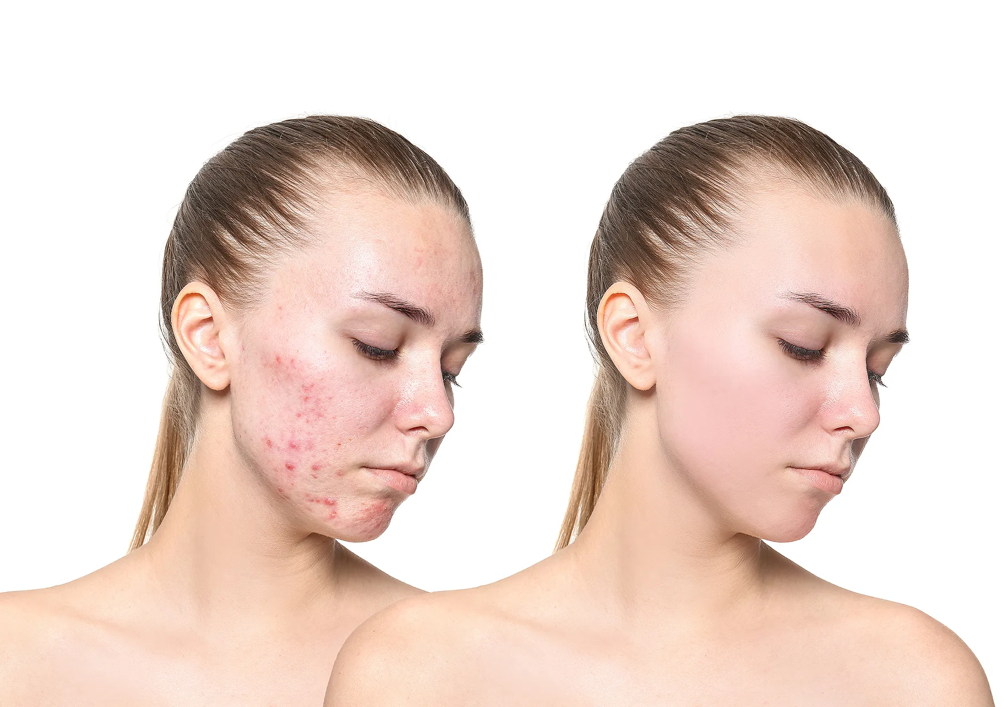 before-after-acne