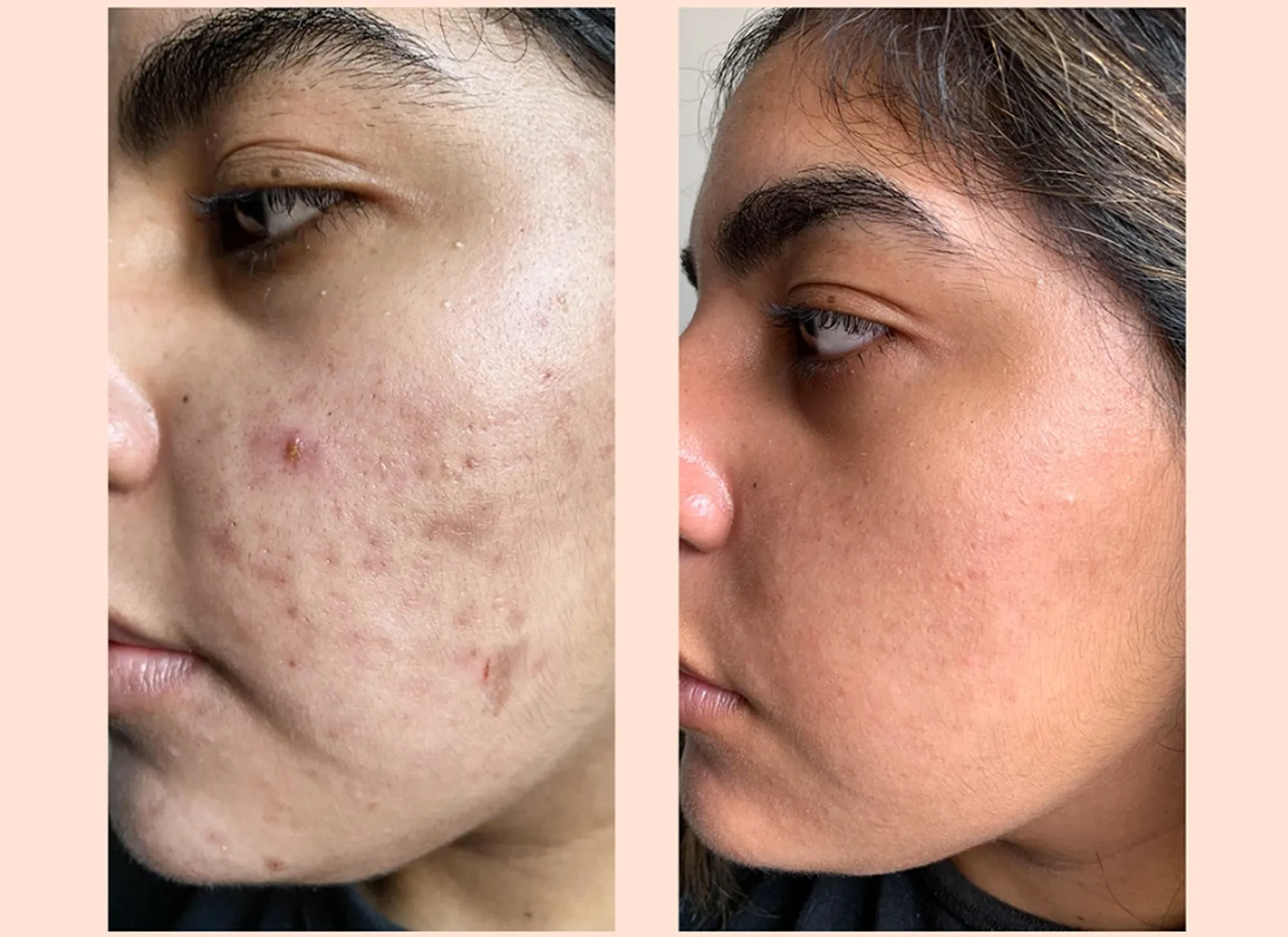 before-after-peace-out-acne