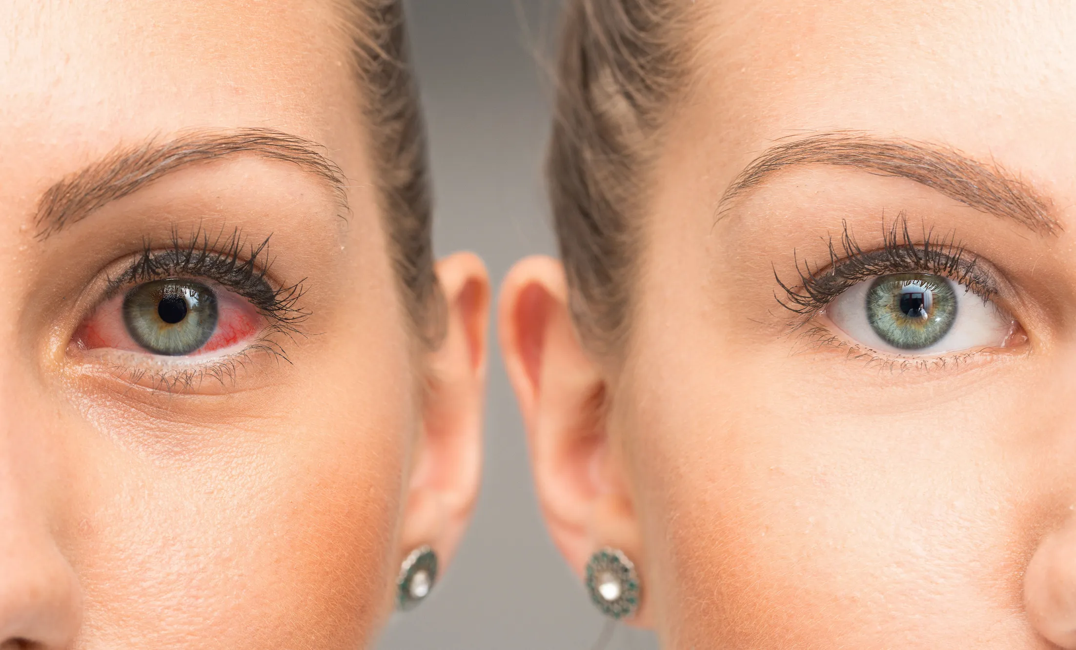 Before-After-Dry-Tired-Eyes-Stock-Photo
