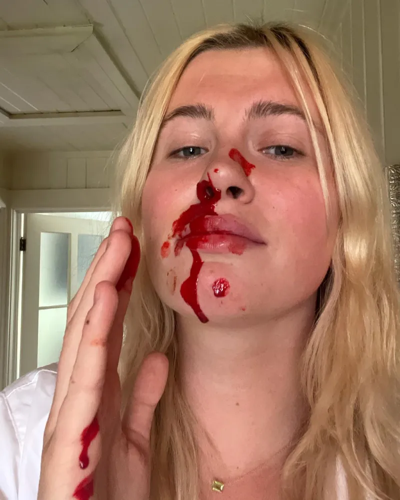 Celebrity Injuries Ireland Baldwin